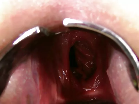 Double fisting anal, prolapse, riche gaping ya talatala ya ndako.